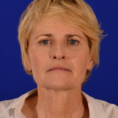 Co2 Laser Resurfacing Before & After Gallery - Patient 380986 - Image 1