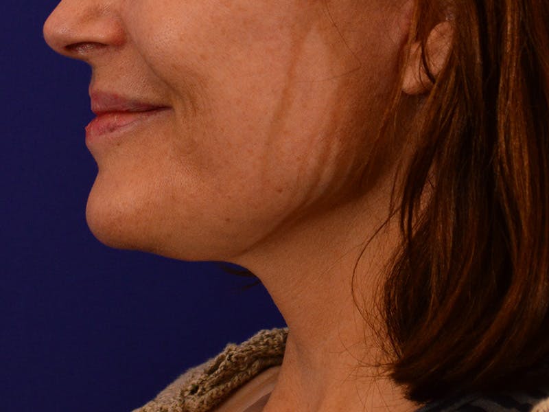 Facelift & Necklift Before & After Gallery - Patient 364835 - Image 10
