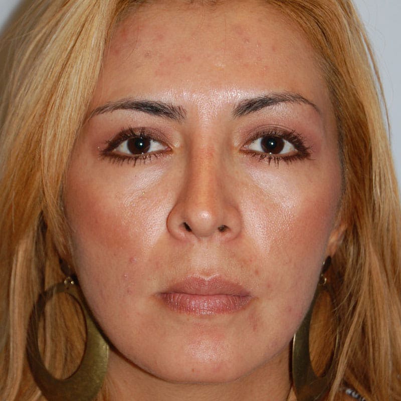 Crooked Nose Before & After Gallery - Patient 303792 - Image 2