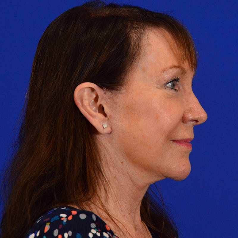 Co2 Laser Resurfacing Before & After Gallery - Patient 374474 - Image 6