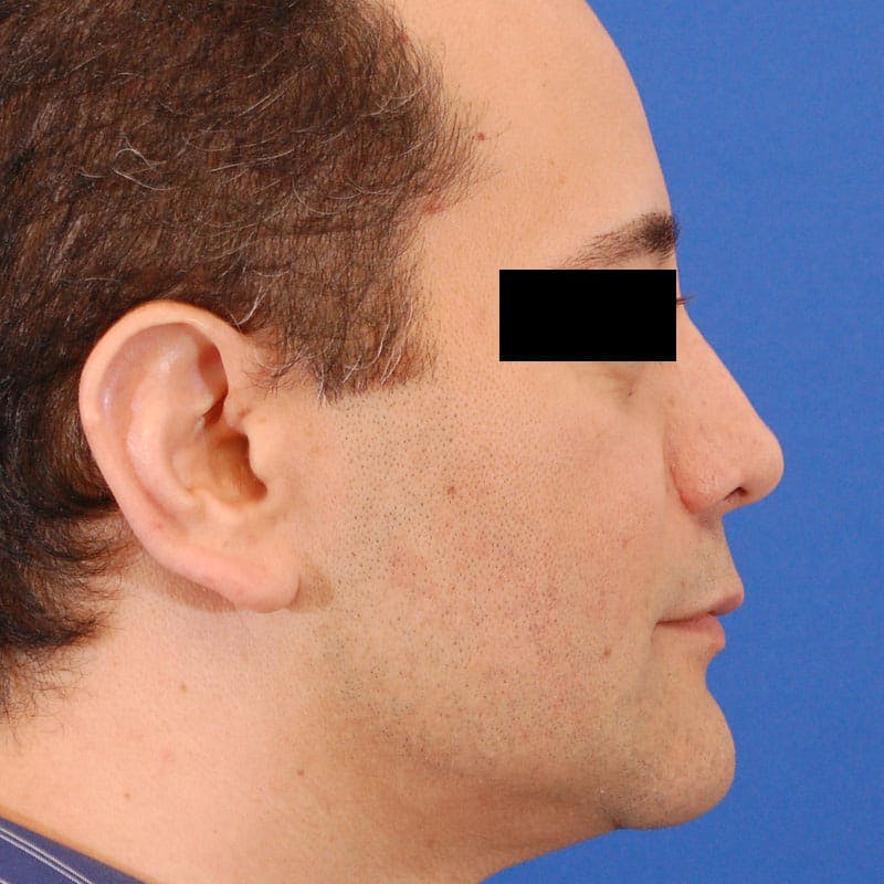 Male Rhinoplasty Before & After Gallery - Patient 785244 - Image 2