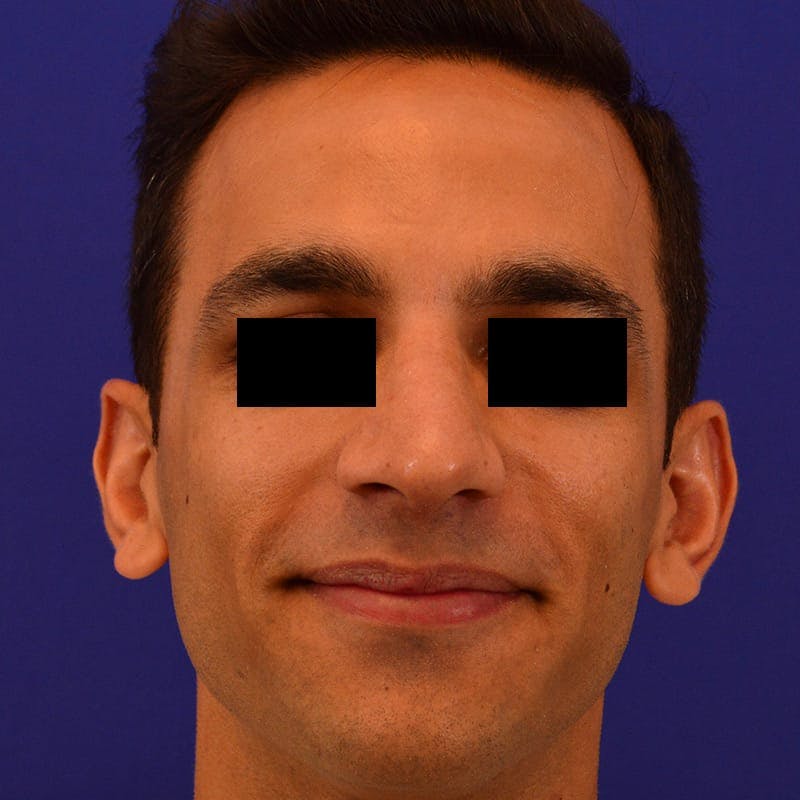 Male Rhinoplasty Before & After Gallery - Patient 249871 - Image 4