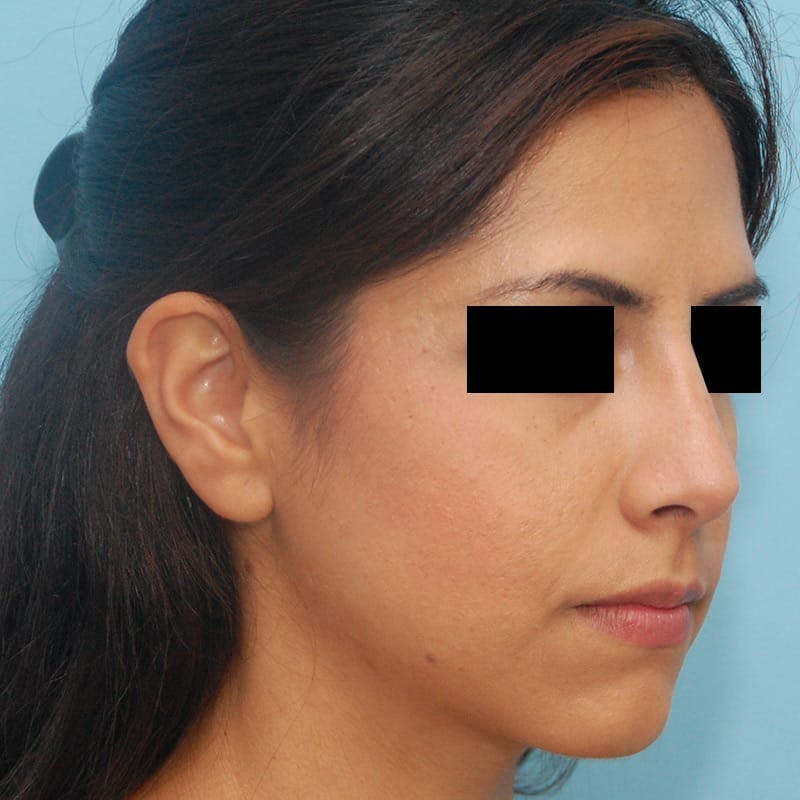 Dorsal Hump Before & After Gallery - Patient 264673 - Image 6