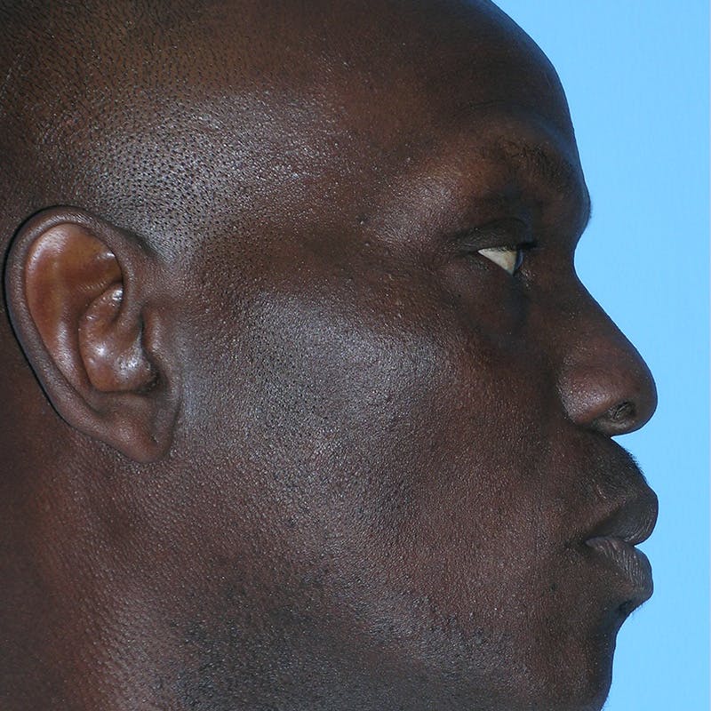 Wide Nose Before & After Gallery - Patient 129259 - Image 5