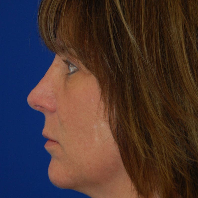 Dorsal Hump Before & After Gallery - Patient 255130 - Image 2