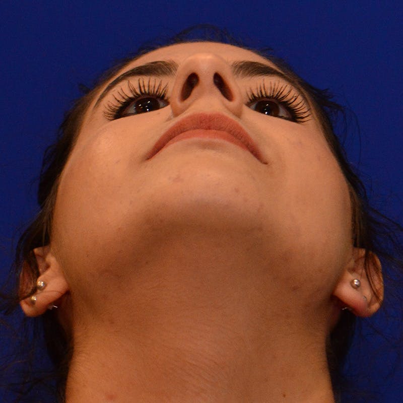 Dorsal Hump Before & After Gallery - Patient 275379 - Image 11
