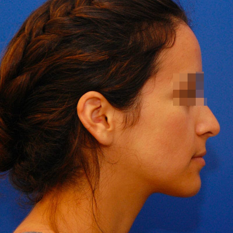 Small Changes Before & After Gallery - Patient 266763 - Image 5