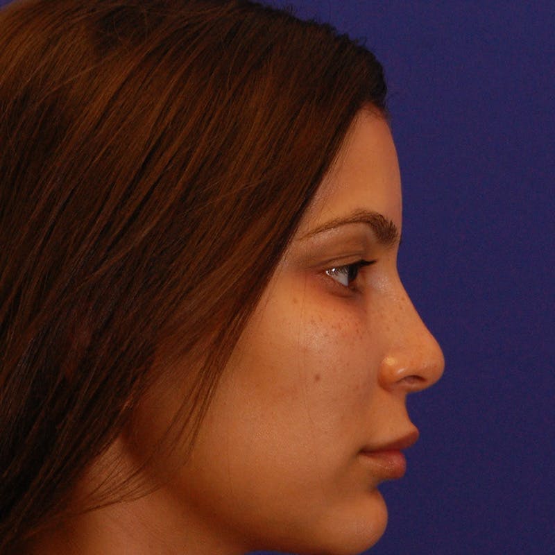 Female Rhinoplasty Before & After Gallery - Patient 396658 - Image 4