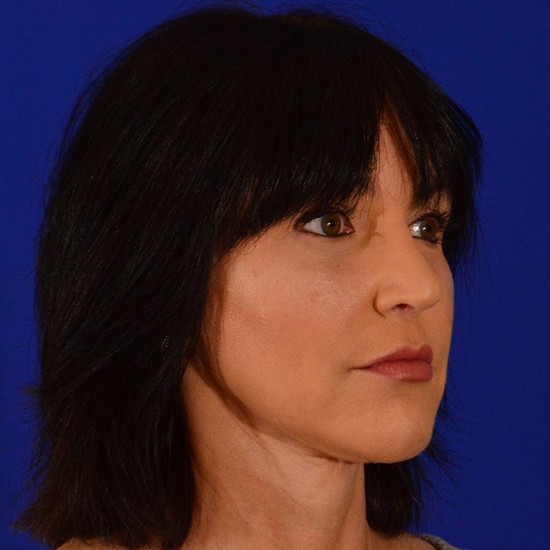 Crooked Nose Before & After Gallery - Patient 158738 - Image 4