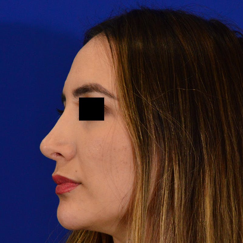 Dorsal Hump Before & After Gallery - Patient 750880 - Image 2