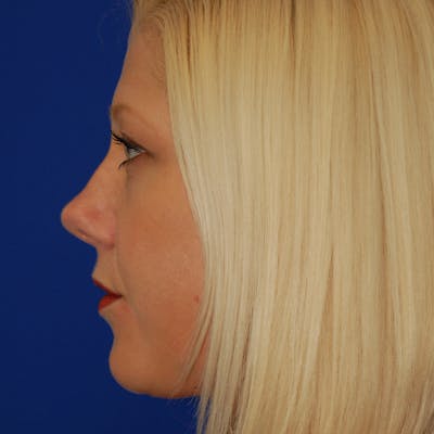 Female Rhinoplasty Before & After Gallery - Patient 206321 - Image 1