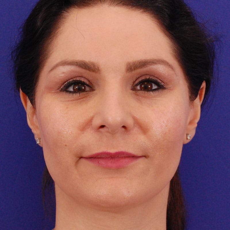 Long Nose Before & After Gallery - Patient 529509 - Image 2