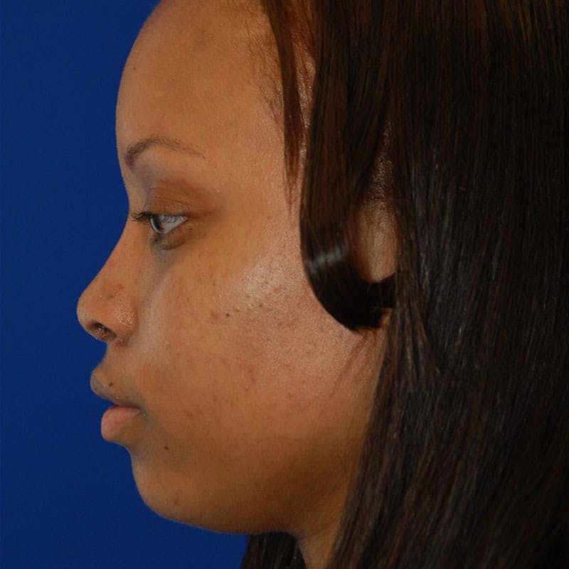 Wide Nose Before & After Gallery - Patient 155718 - Image 6