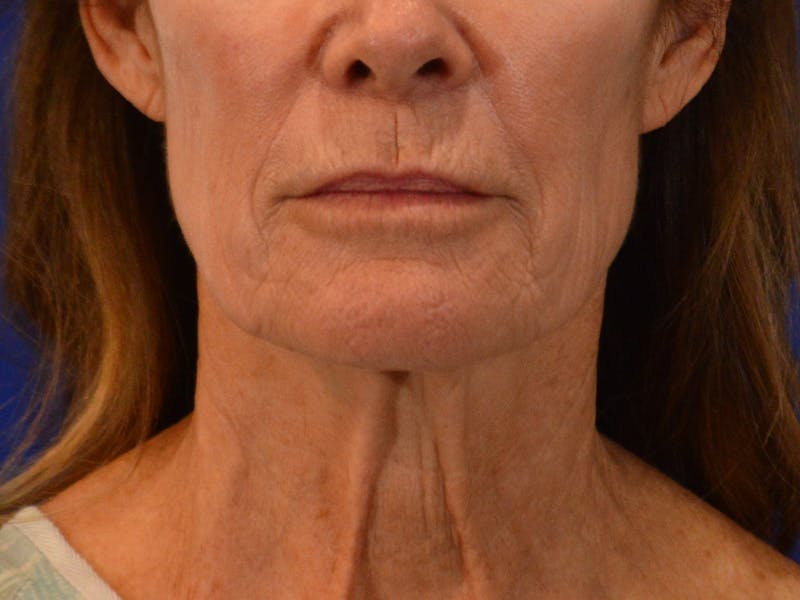 Facelift & Necklift Before & After Gallery - Patient 181377 - Image 1