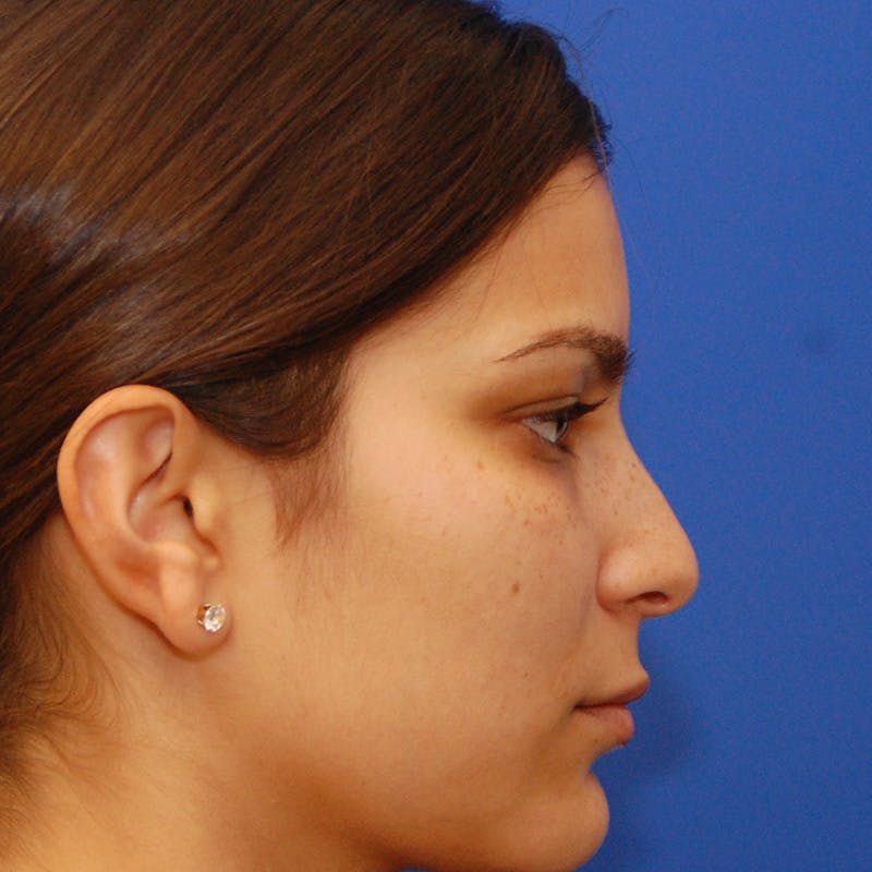 Female Rhinoplasty Before & After Gallery - Patient 396658 - Image 3
