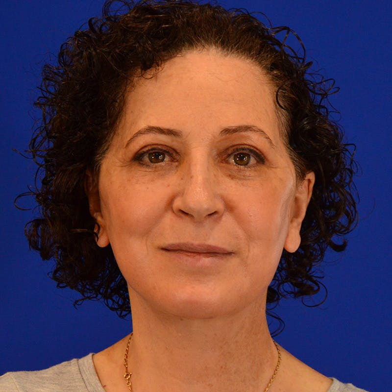 Facelift & Necklift Before & After Gallery - Patient 217555 - Image 2