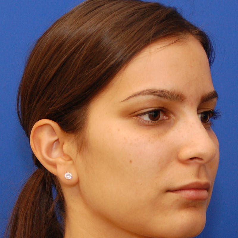 Female Rhinoplasty Before & After Gallery - Patient 396658 - Image 5