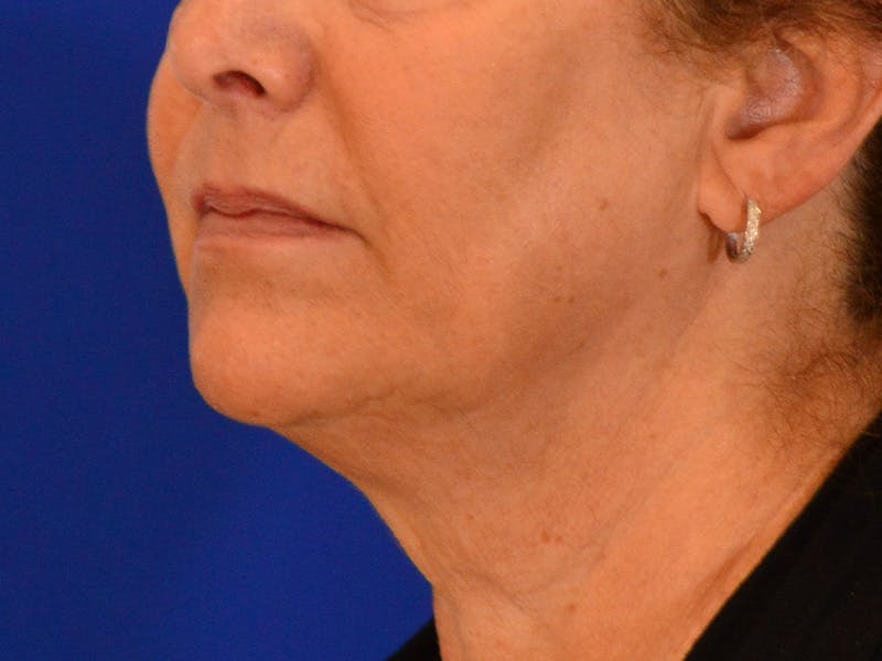 Facelift & Necklift Before & After Gallery - Patient 391454 - Image 1
