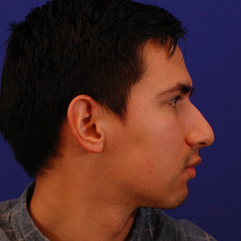 Chin Augmentation Before & After Gallery - Patient 332242 - Image 3