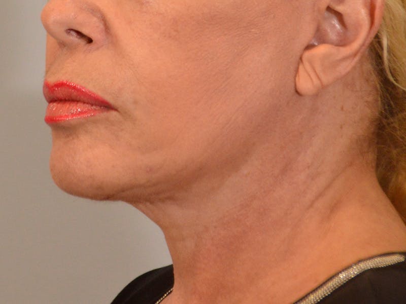 Facelift & Necklift Before & After Gallery - Patient 299407 - Image 4