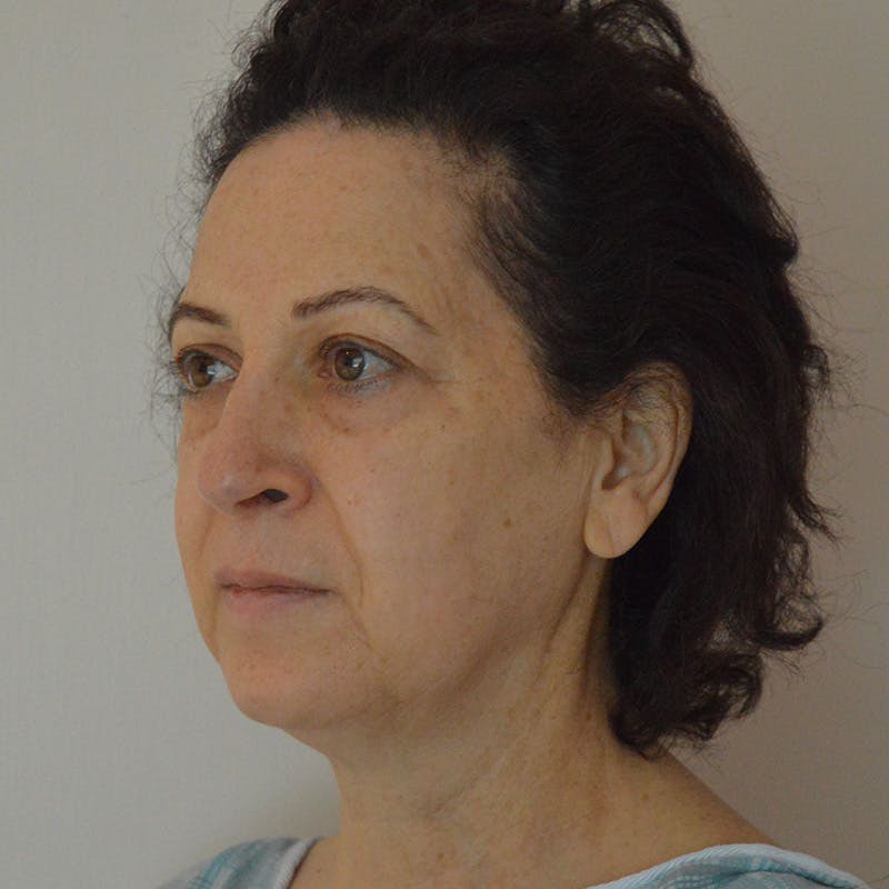 Facelift & Necklift Before & After Gallery - Patient 217555 - Image 7