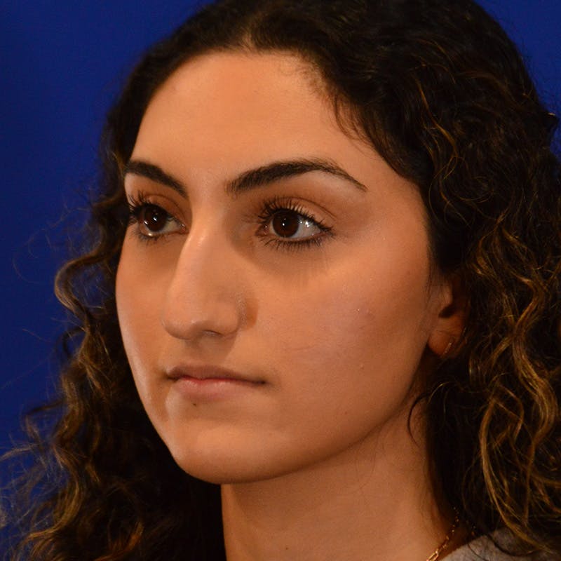 Female Rhinoplasty Before & After Gallery - Patient 224146 - Image 9