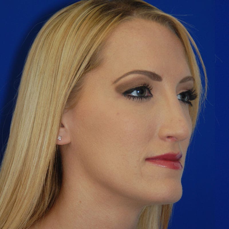 Long Nose Before & After Gallery - Patient 151681 - Image 4