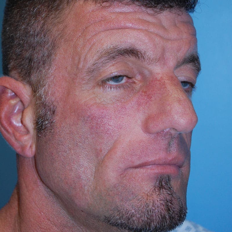 Male Rhinoplasty Before & After Gallery - Patient 359685 - Image 5
