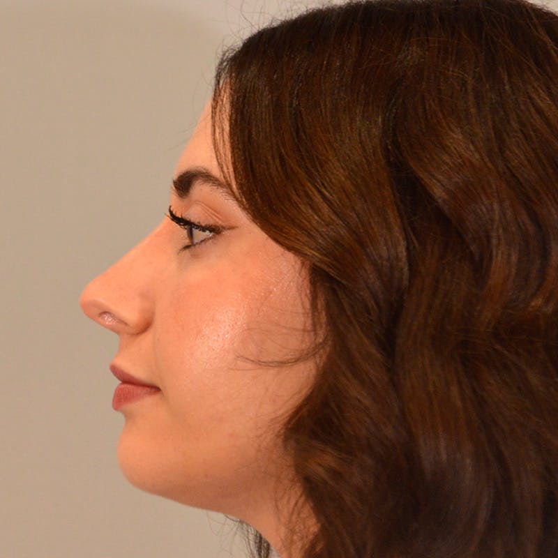Dorsal Hump Before & After Gallery - Patient 275379 - Image 2
