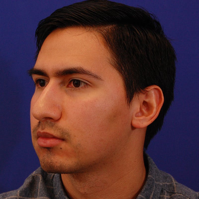 Chin Augmentation Before & After Gallery - Patient 332242 - Image 7