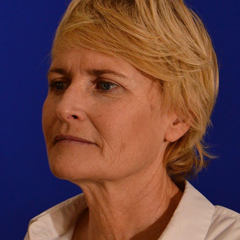 Co2 Laser Resurfacing Before & After Gallery - Patient 380986 - Image 7