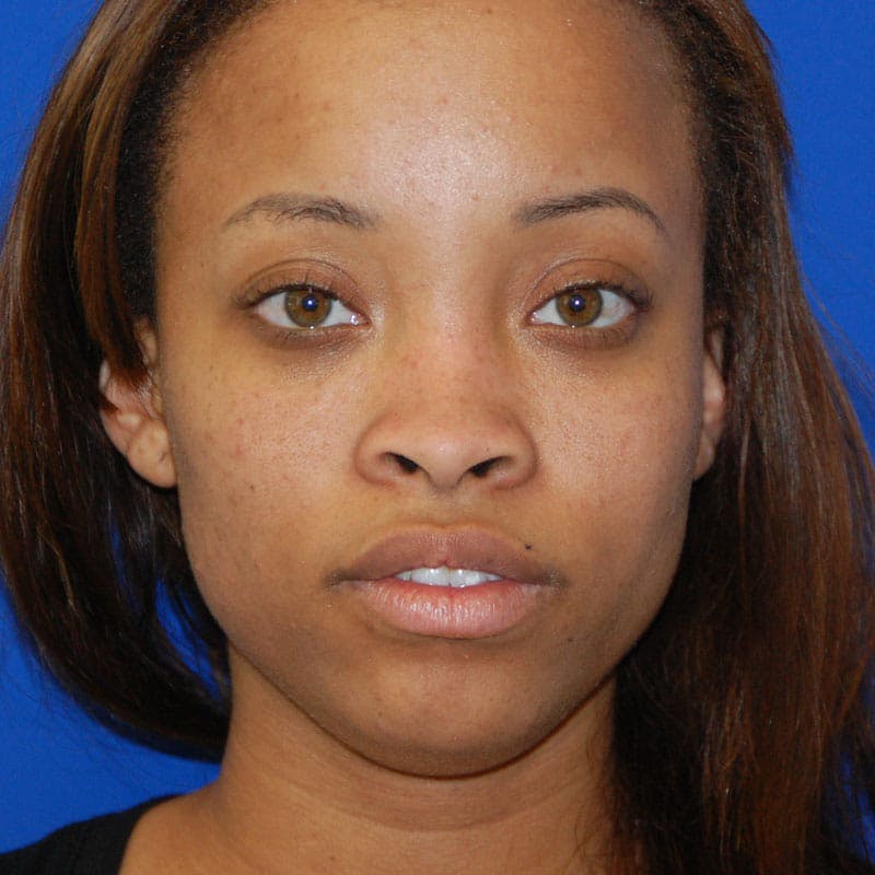 Wide Nose Before & After Gallery - Patient 155718 - Image 1