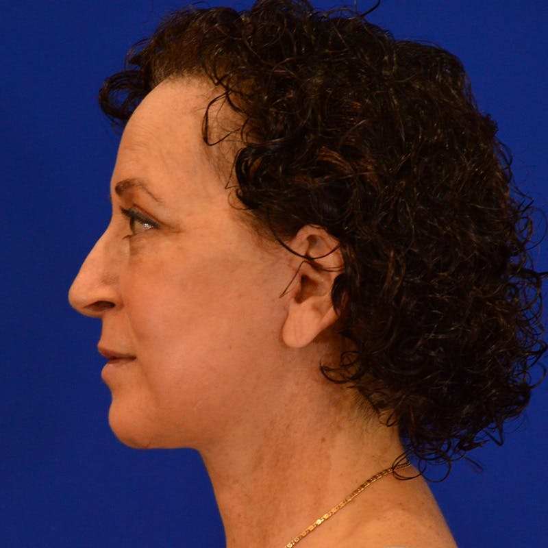 Facelift & Necklift Before & After Gallery - Patient 217555 - Image 10