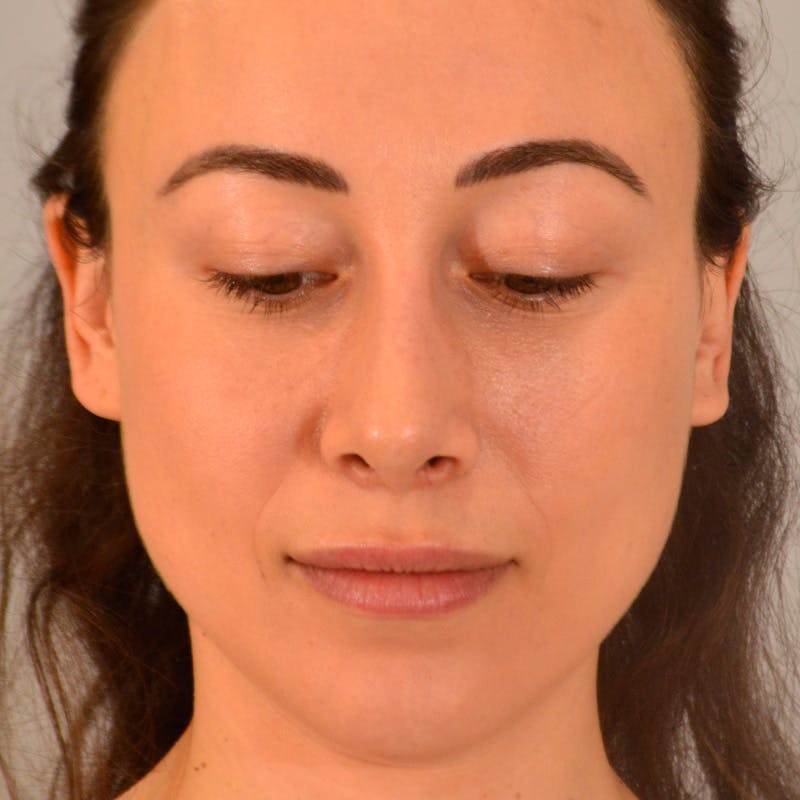 Small Changes Before & After Gallery - Patient 213801 - Image 14
