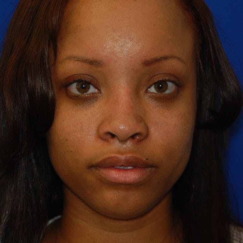 Wide Nose Before & After Gallery - Patient 155718 - Image 2