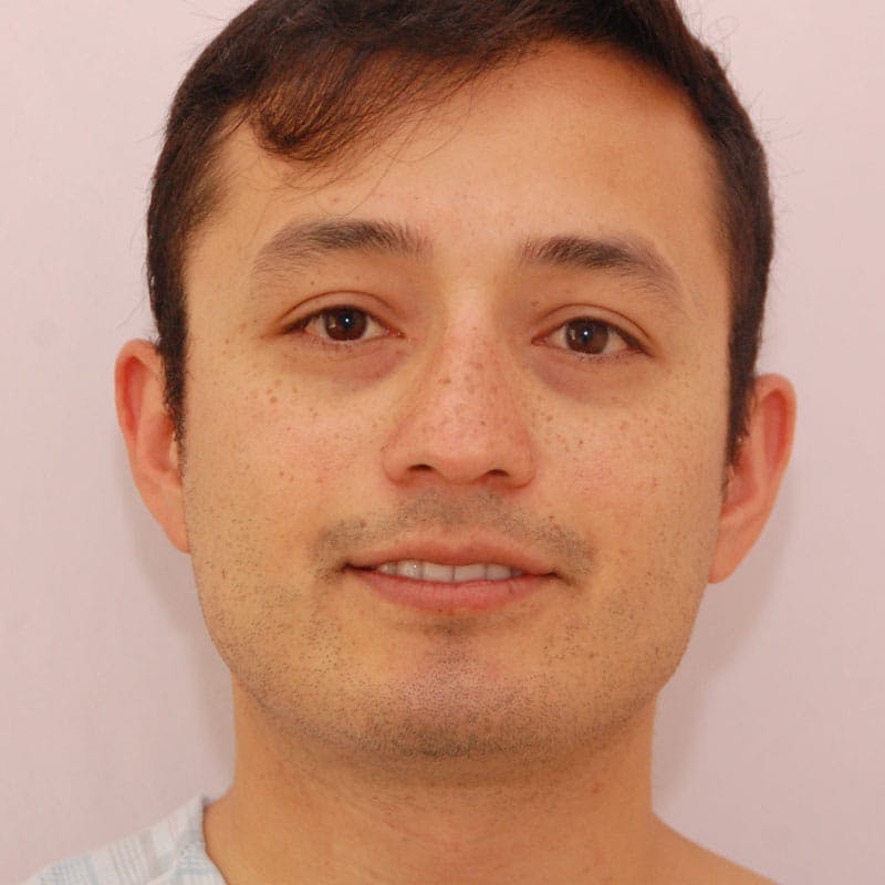 Ethnic Rhinoplasty Before & After Gallery - Patient 408370 - Image 3