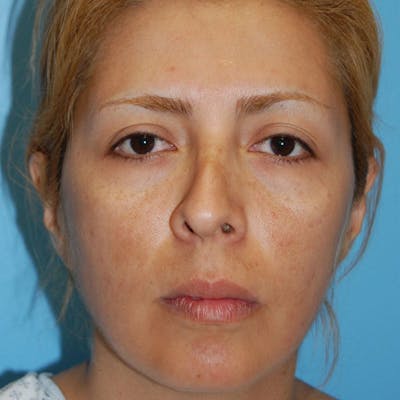 Crooked Nose Before & After Gallery - Patient 303792 - Image 1