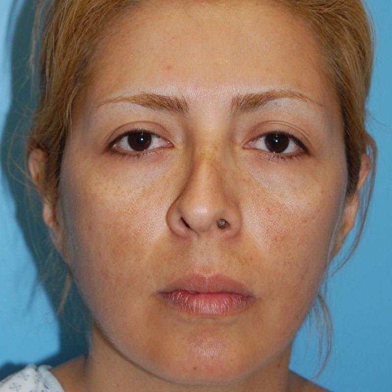 Crooked Nose Before & After Gallery - Patient 303792 - Image 1