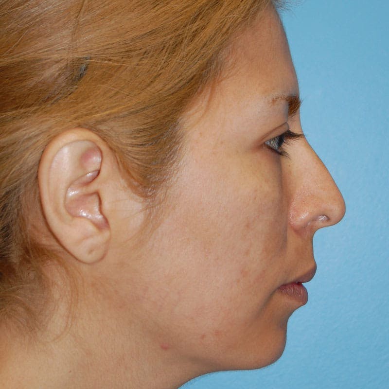 Crooked Nose Before & After Gallery - Patient 303792 - Image 5