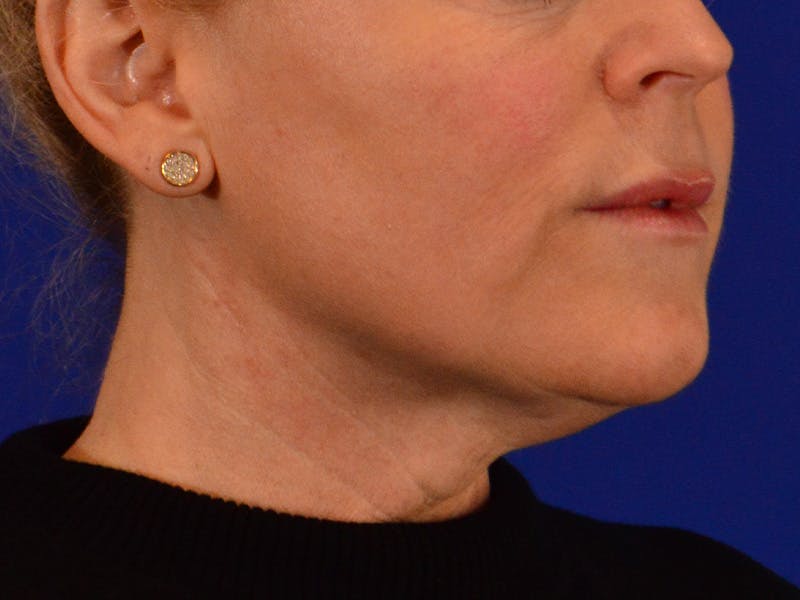 Facelift & Necklift Before & After Gallery - Patient 654569 - Image 3