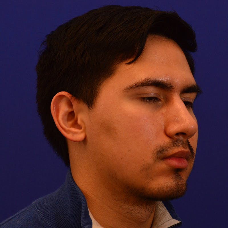 Chin Augmentation Before & After Gallery - Patient 332242 - Image 6