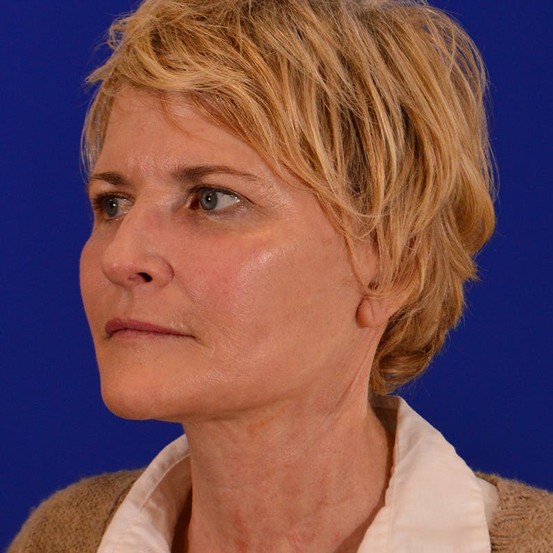 Co2 Laser Resurfacing Before & After Gallery - Patient 380986 - Image 8