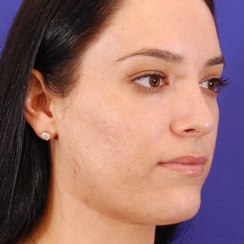 Dorsal Hump Before & After Gallery - Patient 319034 - Image 5