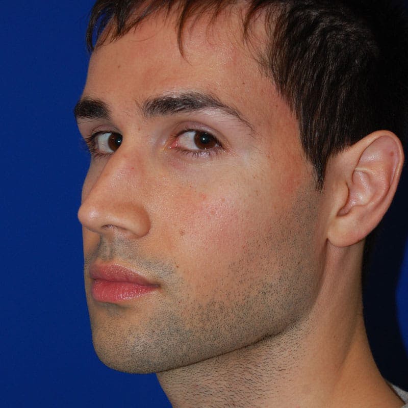Crooked Nose Before & After Gallery - Patient 164777 - Image 3