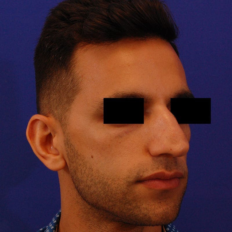 Male Rhinoplasty Before & After Gallery - Patient 249871 - Image 5