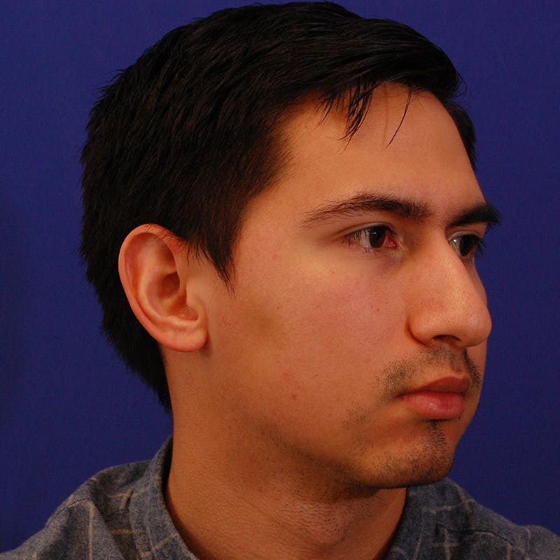 Chin Augmentation Before & After Gallery - Patient 332242 - Image 5