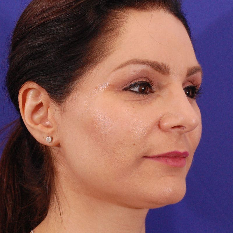 Long Nose Before & After Gallery - Patient 529509 - Image 4