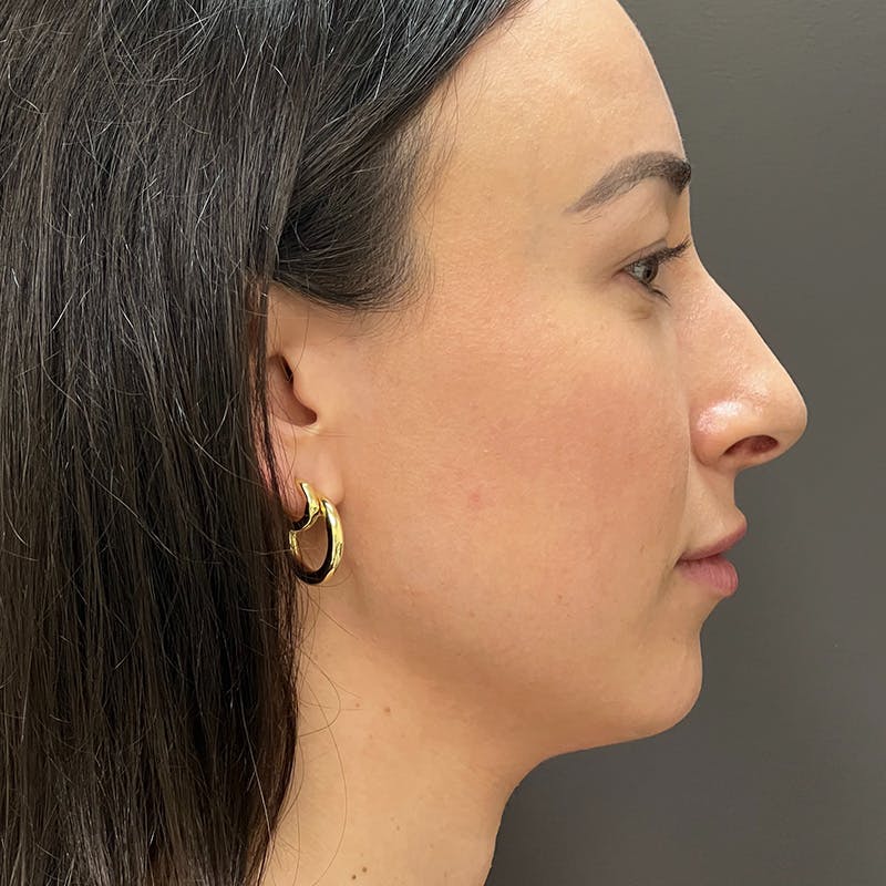 Small Changes Before & After Gallery - Patient 213801 - Image 5