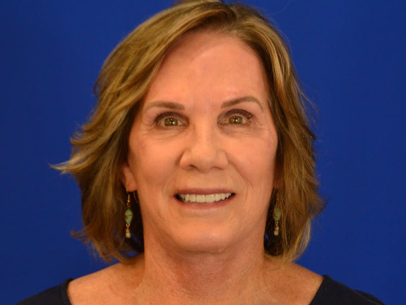 Facelift & Necklift Before & After Gallery - Patient 536616 - Image 2