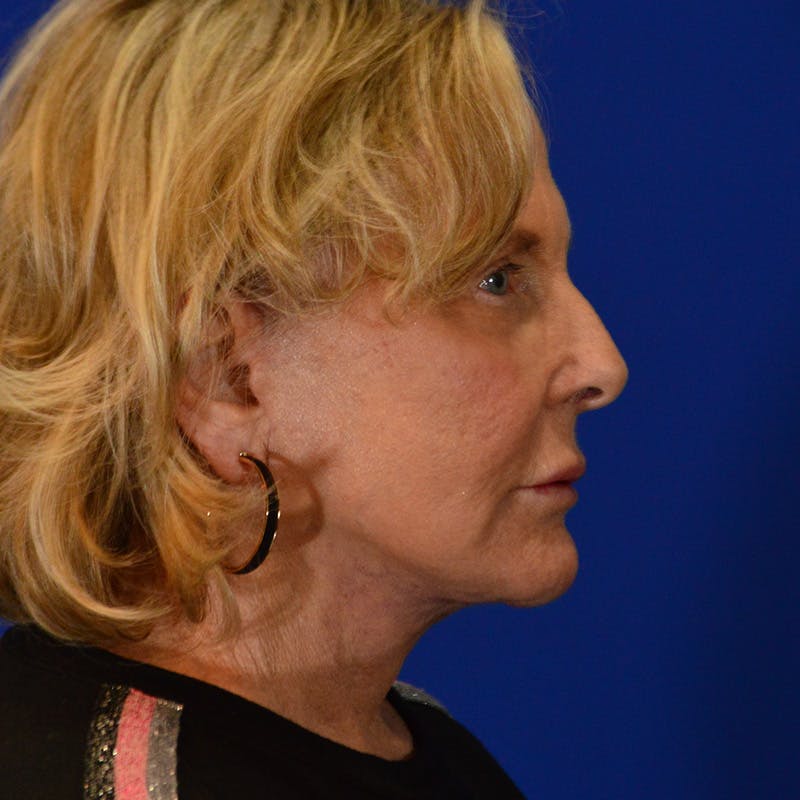 Co2 Laser Resurfacing Before & After Gallery - Patient 940417 - Image 6